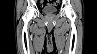 Prostata - CT vorher coronal_detail
