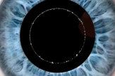 Laseroperation - Pupille